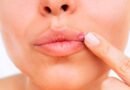 Herpes labial