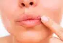 Herpes labial