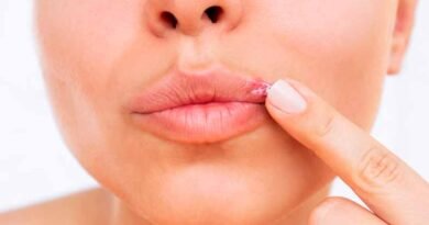 Herpes labial