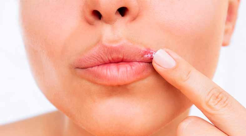 Herpes labial
