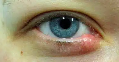 Qué son los orzuelos en los ojos y cómo prevenirlos orzuelos