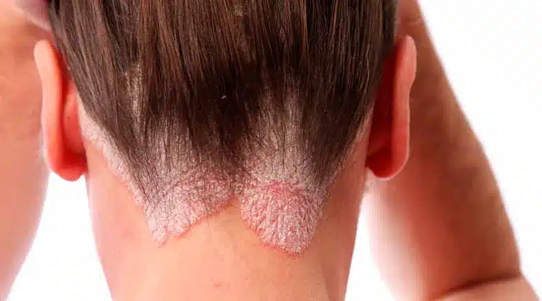 Psoriasis