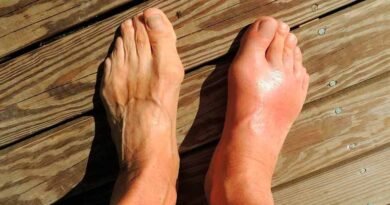 Recomendaciones para prevenir la gota 1 la gota