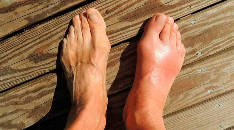 Recomendaciones para prevenir la gota 1 la gota