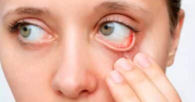 la conjuntivitis