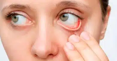 la conjuntivitis