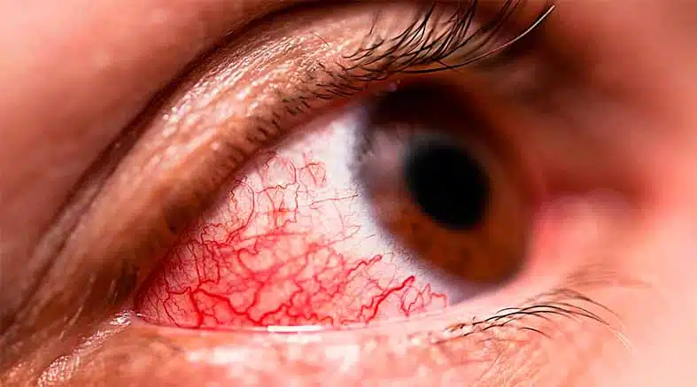 la conjuntivitis la conjuntivitis