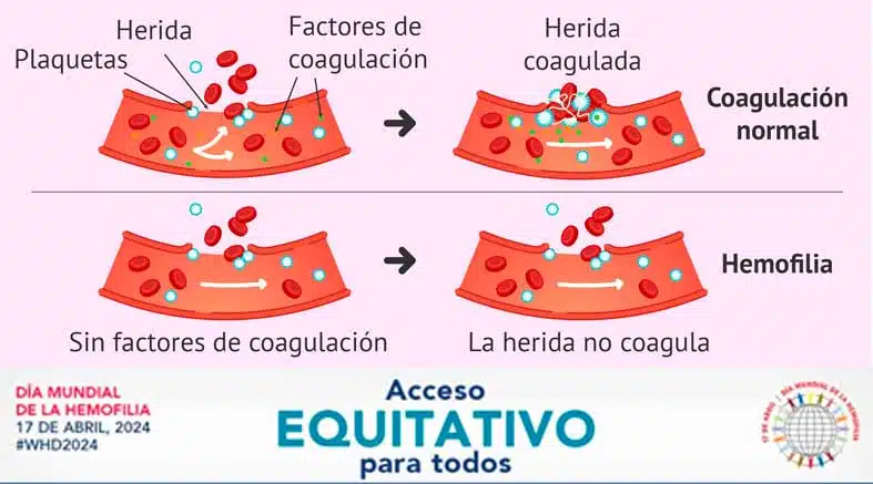 Hemofilia