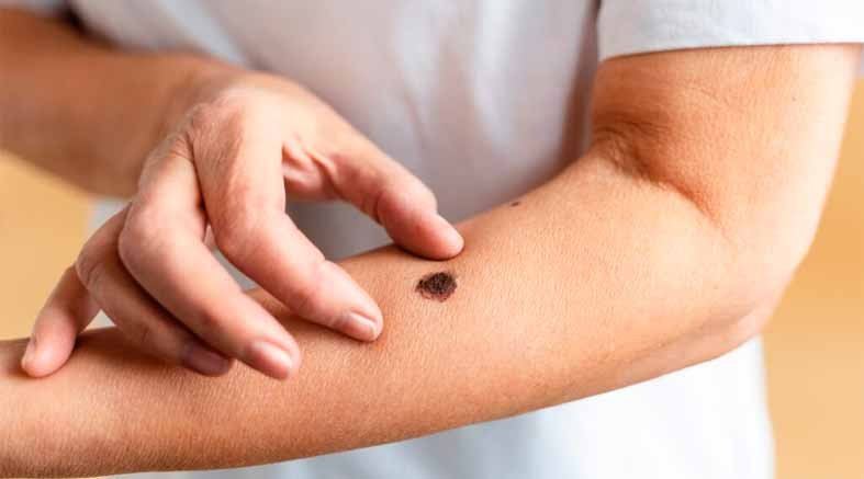 Melanoma