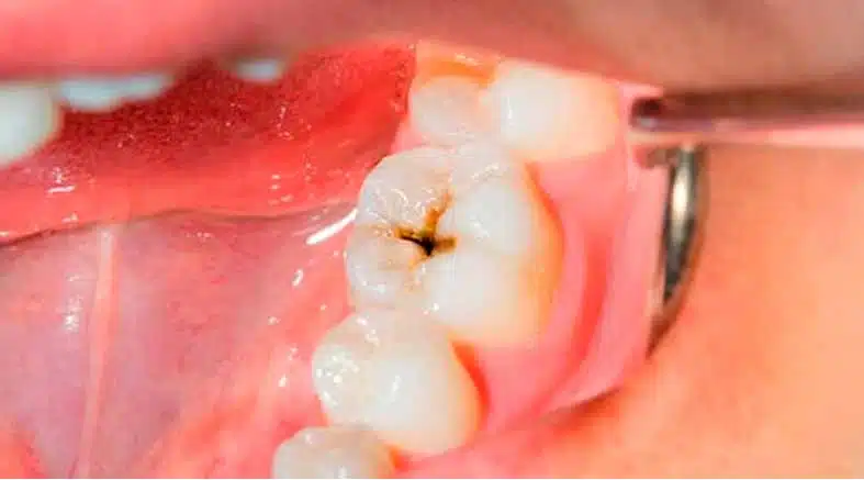 caries caries