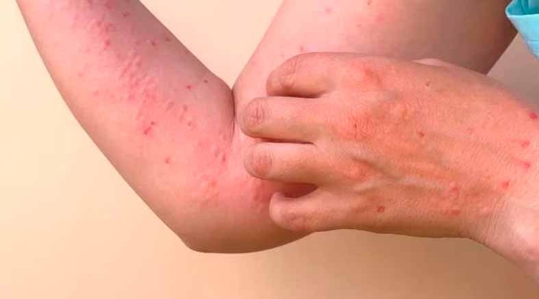chikungunya