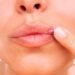 Herpes labial